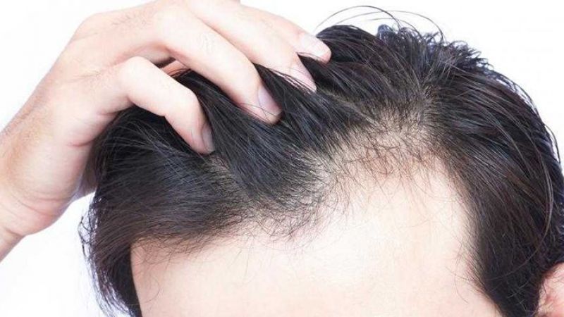 Saç dökülmesine karşı hiç duymadığınız yöntem: Saç dökülmesi tedavi yöntemleri nelerdir? Saç neden dökülür? 3