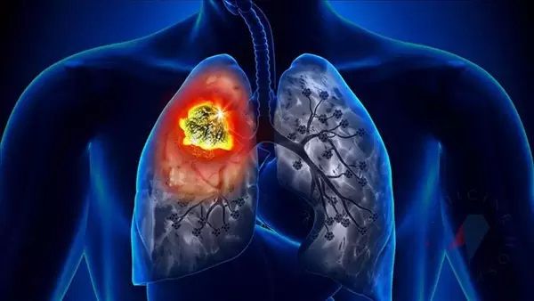 Dünyada en yaygın kanser türlerinden biri! Akciğer kanseri semptomları nelerdir? 2