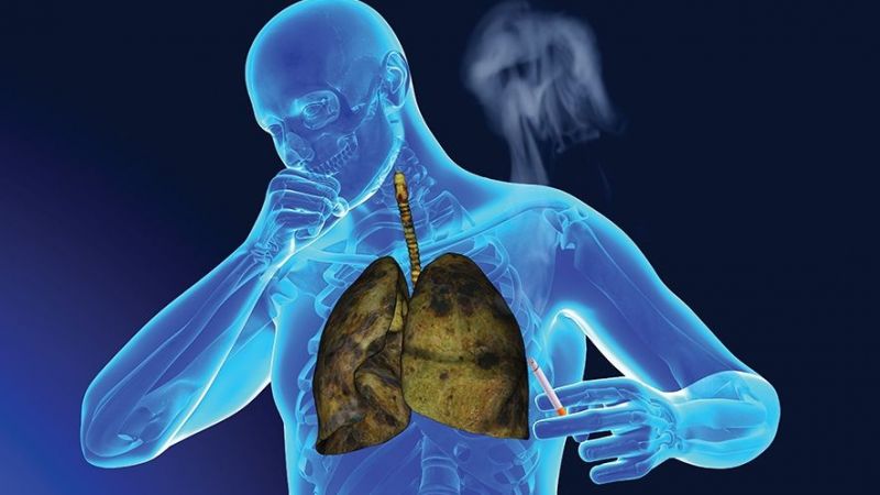 Dünyada en yaygın kanser türlerinden biri! Akciğer kanseri semptomları nelerdir? 4