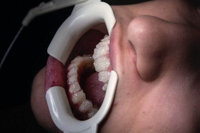 Evde bulunan malzemelerle diş tartarlarını ve plakları bu teknikle yok edin 5