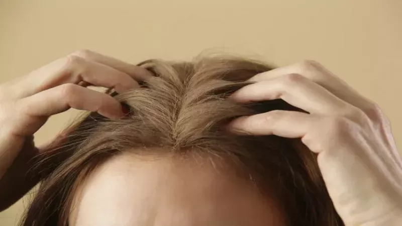 Saç diplerinizde bu belirtiler ortaya çıktıysa hemen doktora gidin: Kel kalmadan çaresine bakın… Küçük bir bölgede başlayıp yayılıyor 1