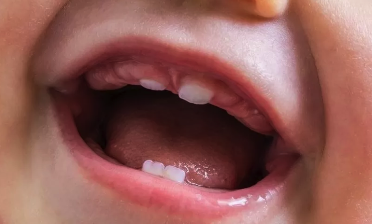 Bebeklerde diş çıkarma ağrısını hafifletmek için doğal yöntemler. Diş çıkarmak ağrıya neden olur mu? İpuçları ve pratik bilgiler. 1