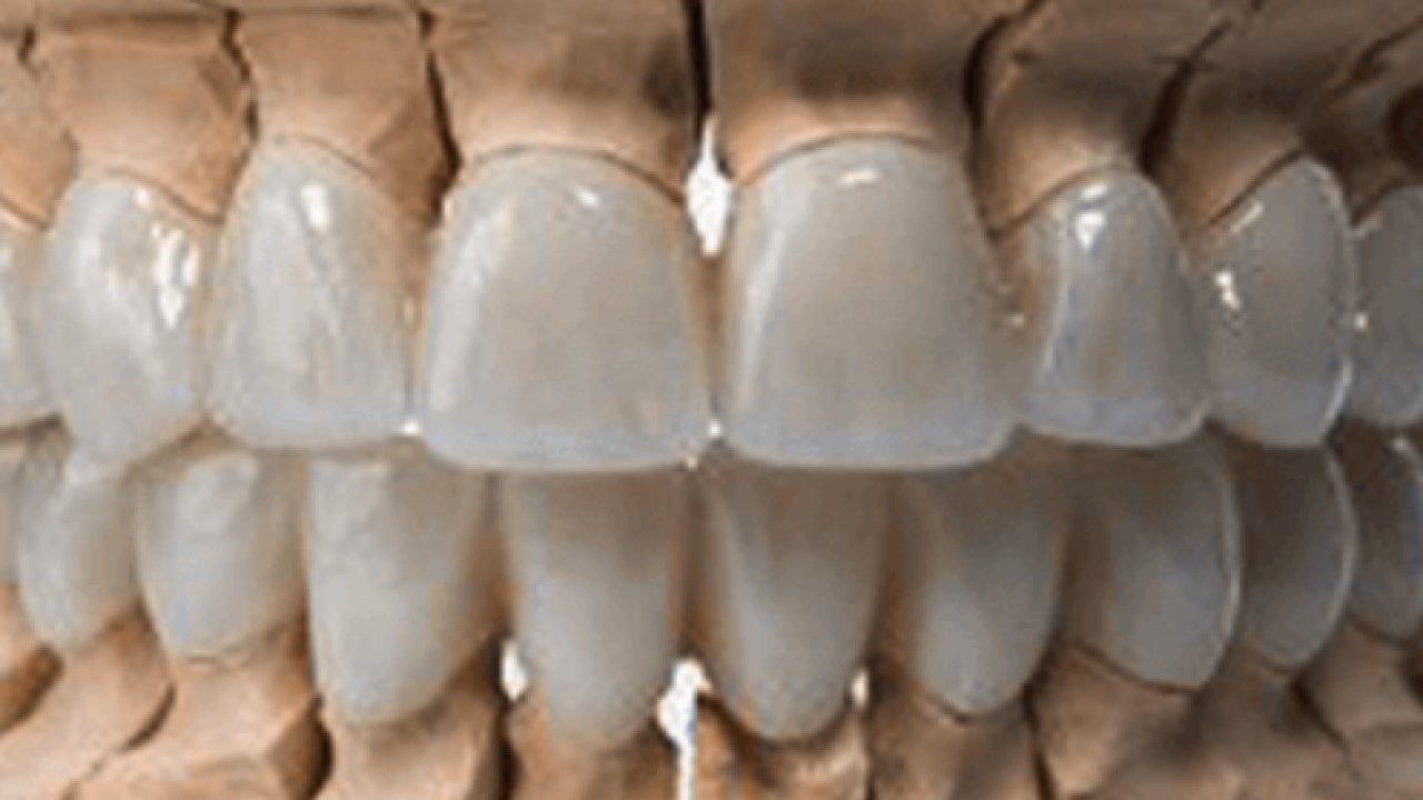 Protez Diş Nedir, Ne İşe Yarar?