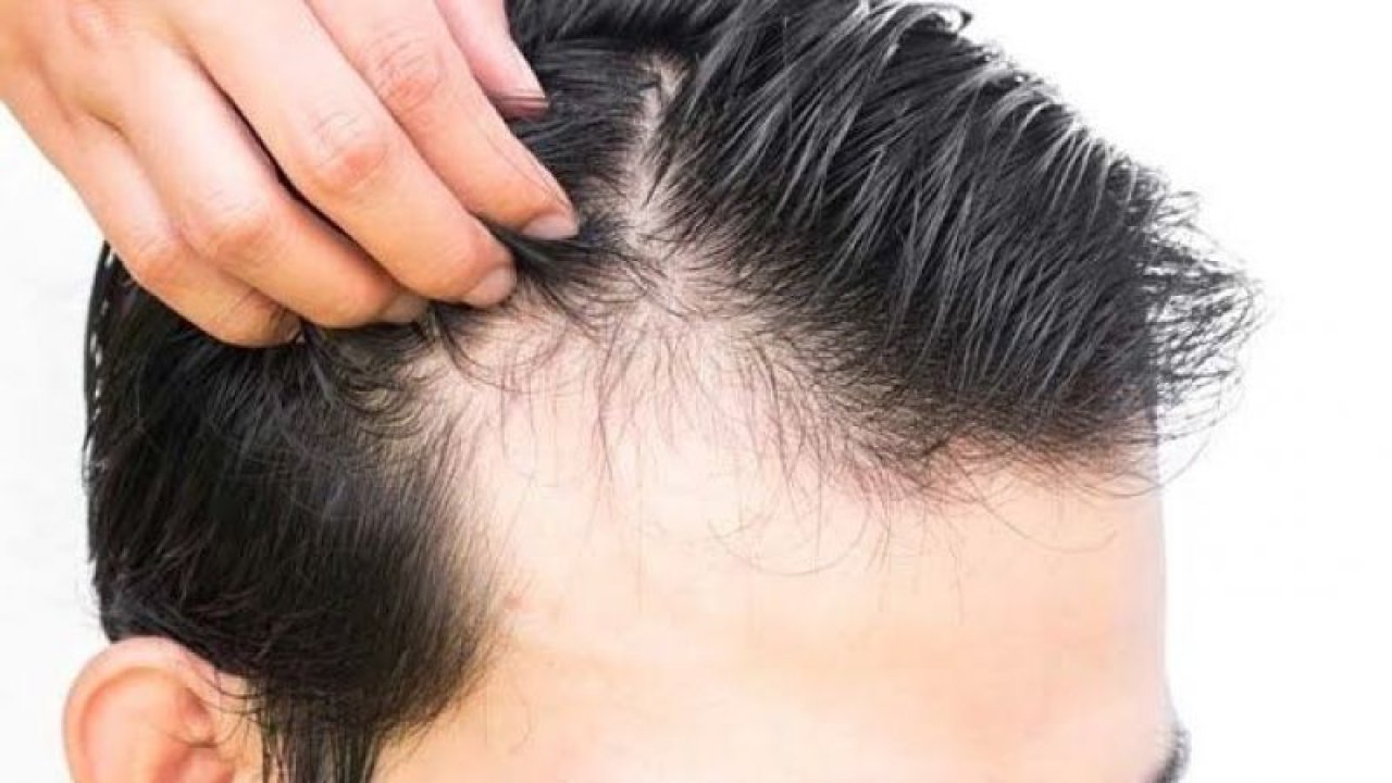 Saç dökülmesine karşı hiç duymadığınız yöntem: Saç dökülmesi tedavi yöntemleri nelerdir? Saç neden dökülür?