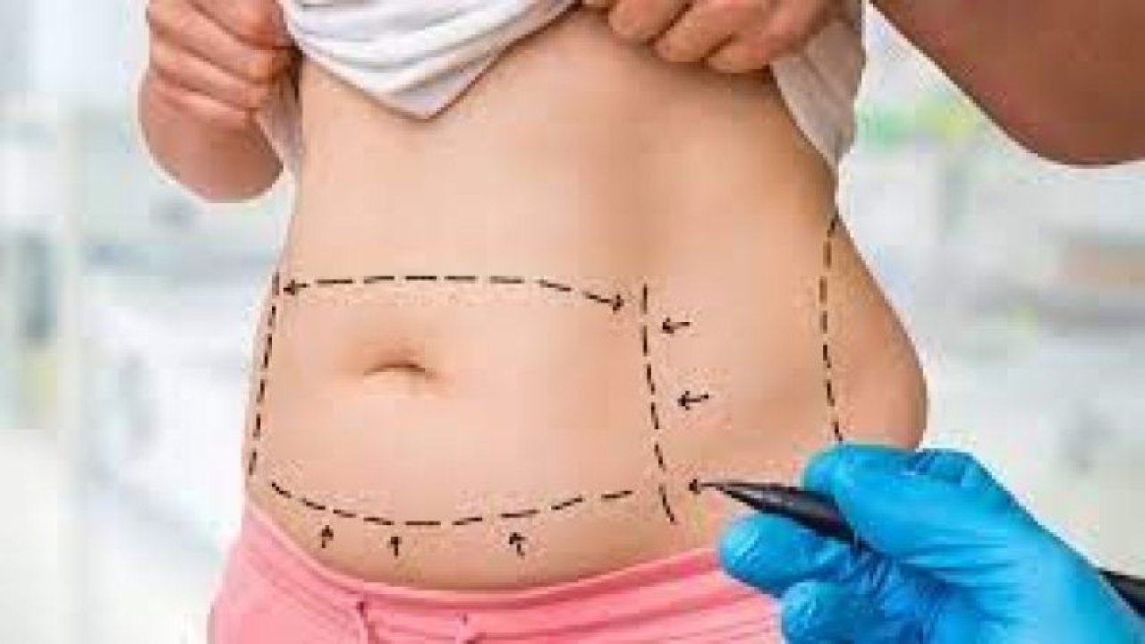 Liposuction nedir, ne işe yarar? Liposuction(yağ aldırma) ile kilo vermek mümkün mü?