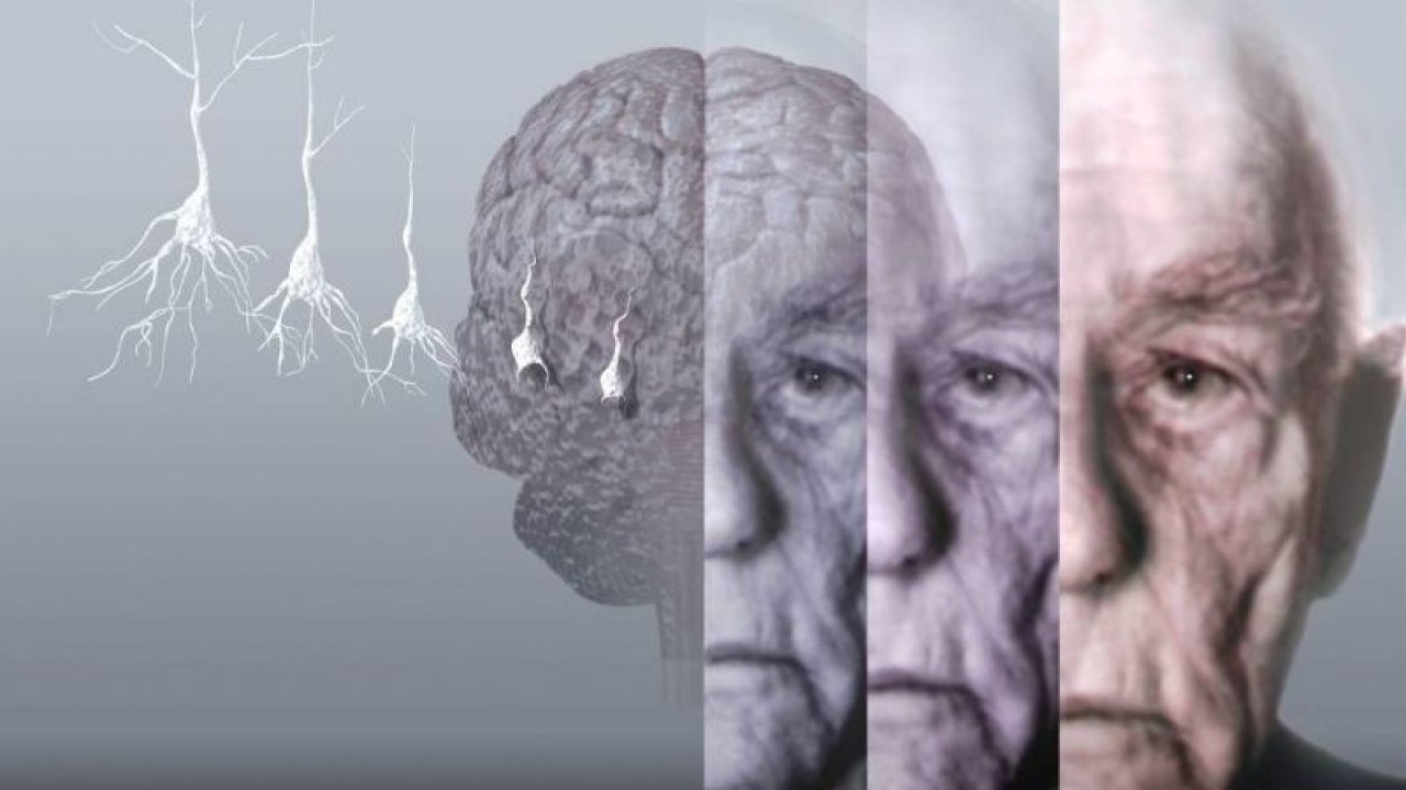 Demans ile Alzheimer’in aynı hastalık olmadığı ortaya çıktı! Alzheimer’in demansın alt tipi bir hastalık olduğu aktarıldı!