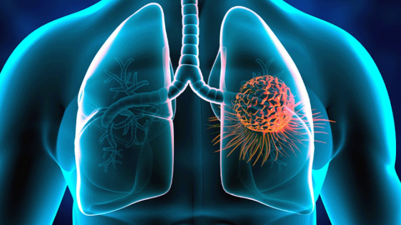 Dünyada en yaygın kanser türlerinden biri! Akciğer kanseri semptomları nelerdir?