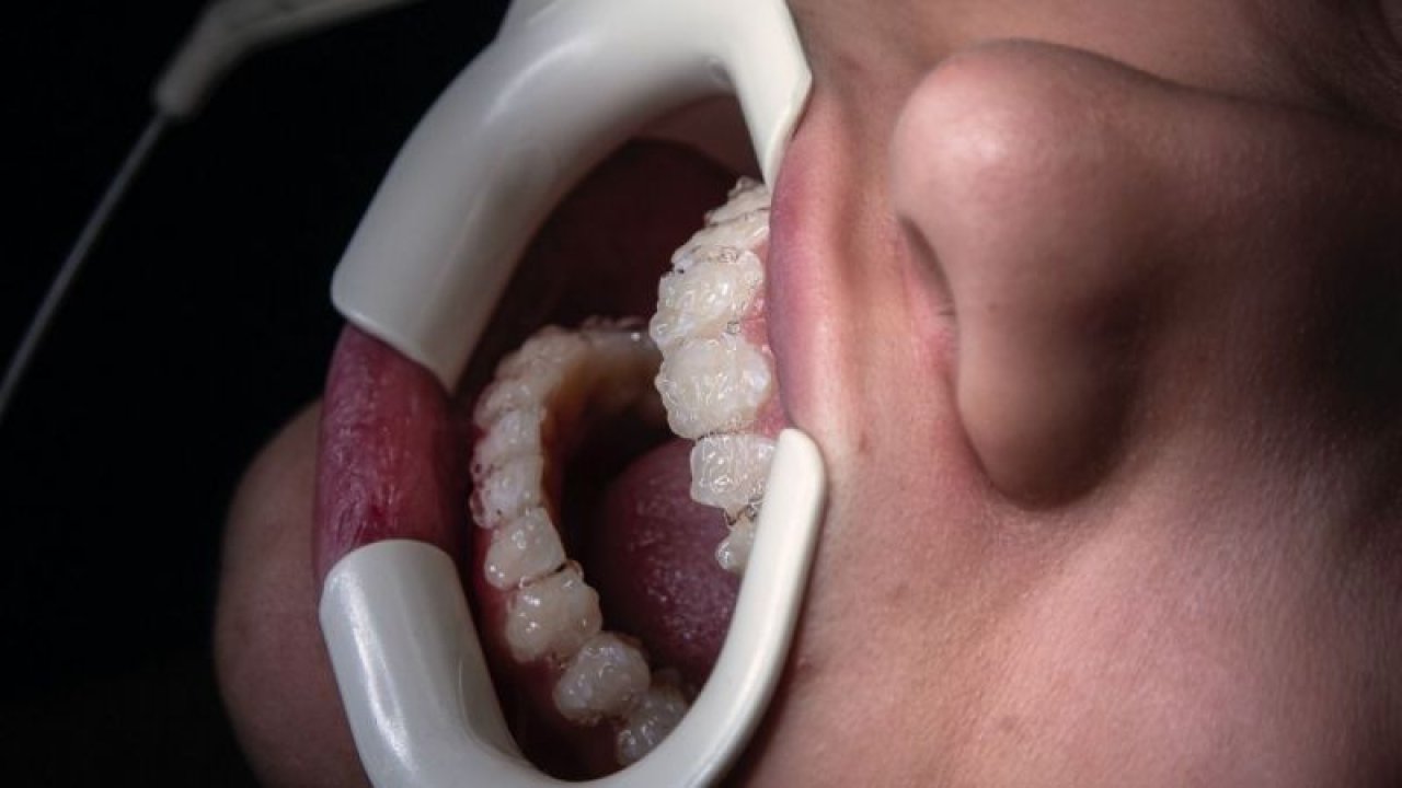 Evde bulunan malzemelerle diş tartarlarını ve plakları bu teknikle yok edin