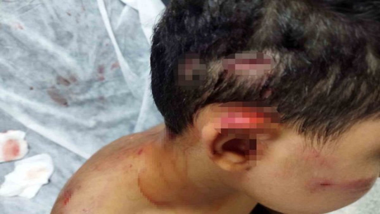 Gaziantep'te Köpek Dehşeti! Köpeğin saldırısına uğrayan çocuğun kafasında derin yaralar oluştu